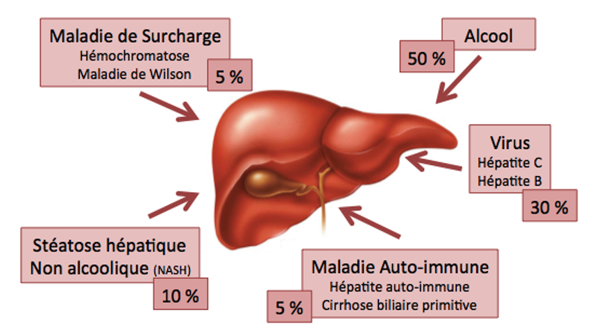 Les causes de cirrhose < monhepatogastro