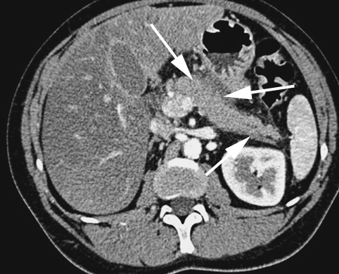 Épidémiologie De L'hépatite B